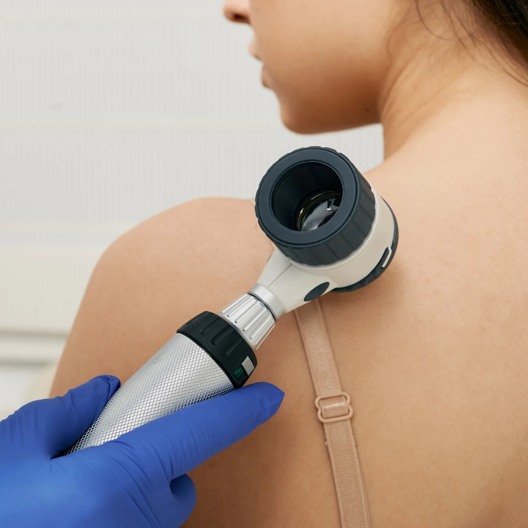 A dermatoscope being used to examine skin on the upper back.