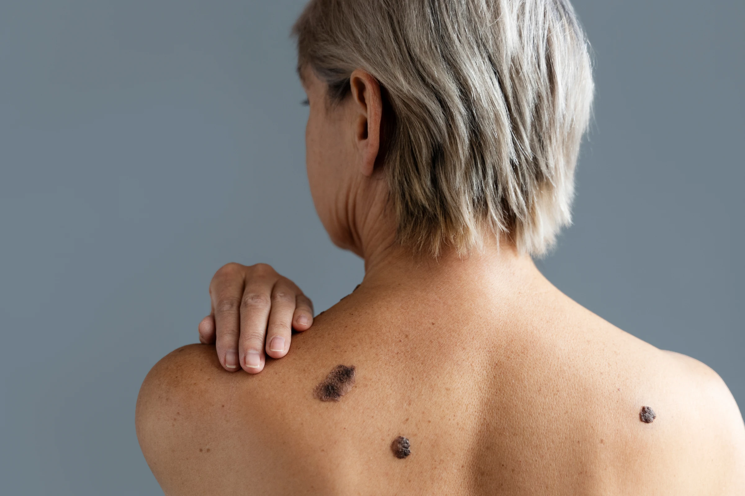Skin spots visible on a person’s upper back.