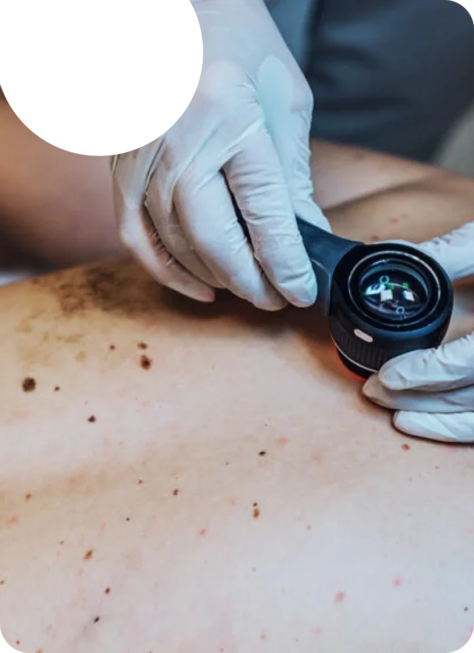 A clinician inspecting a mole with a dermatoscope.
