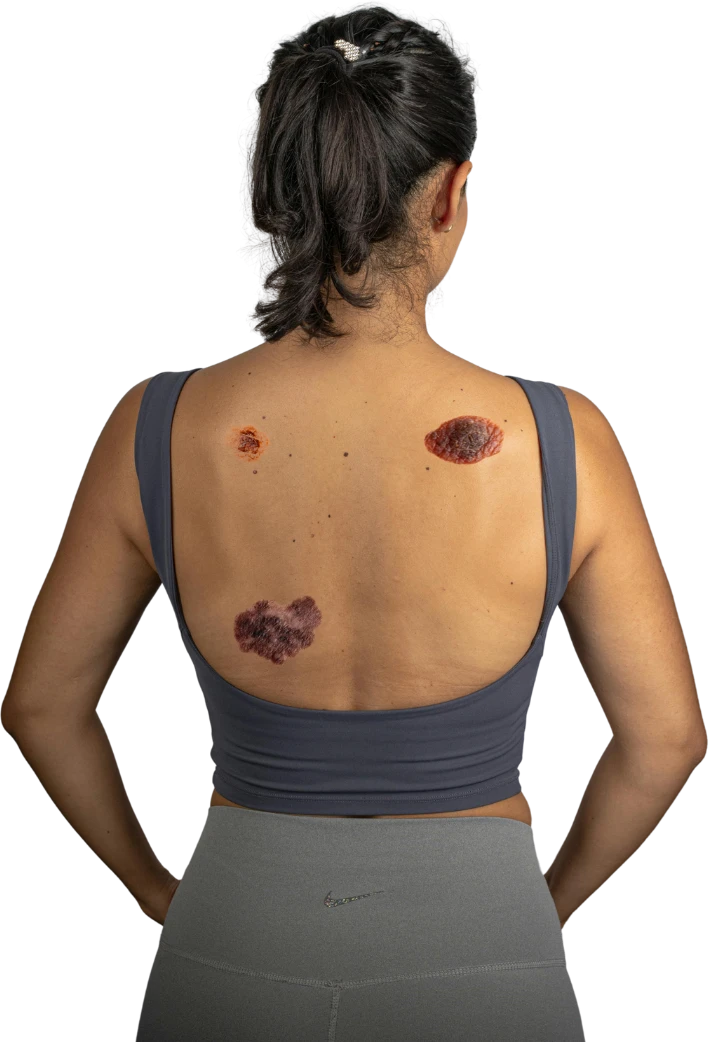 Educational illustration showing skin lesions on a person’s back.