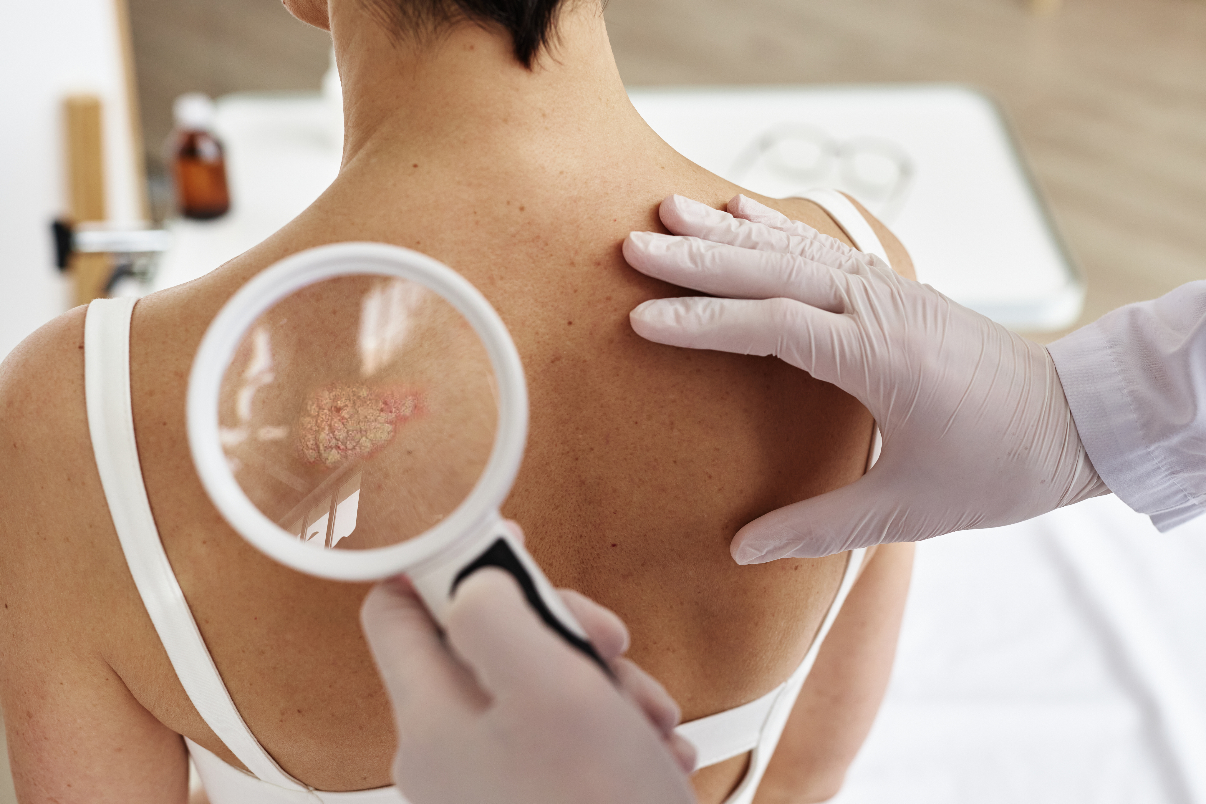 A clinician examining skin on a patient’s upper back.