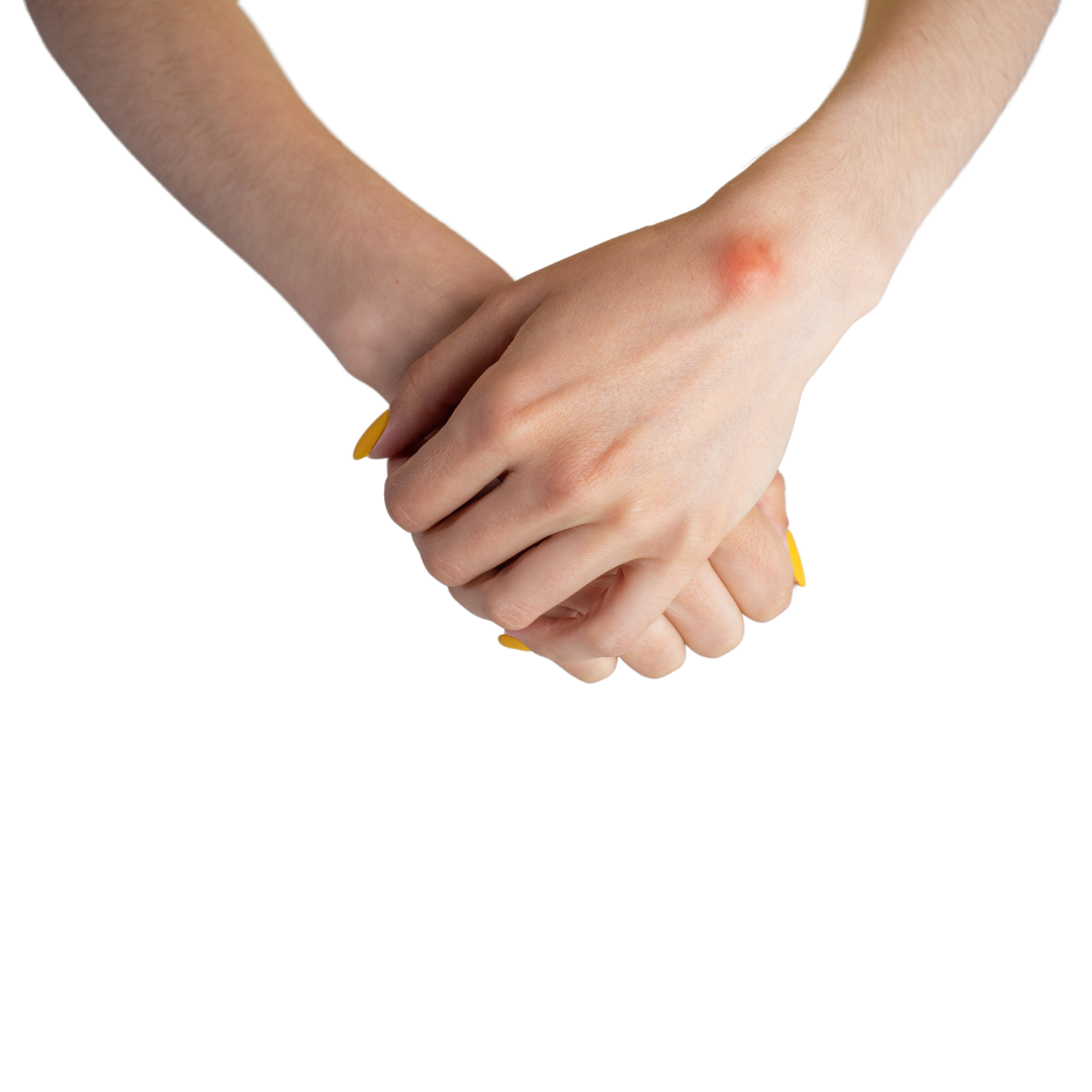 A visible lump at the wrist.