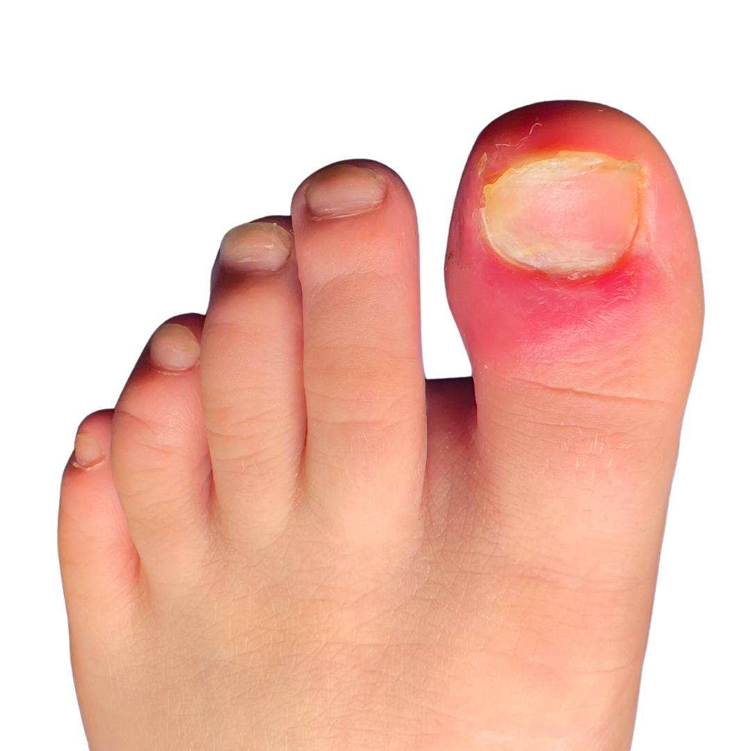 Close view of a toe with redness around the nail.