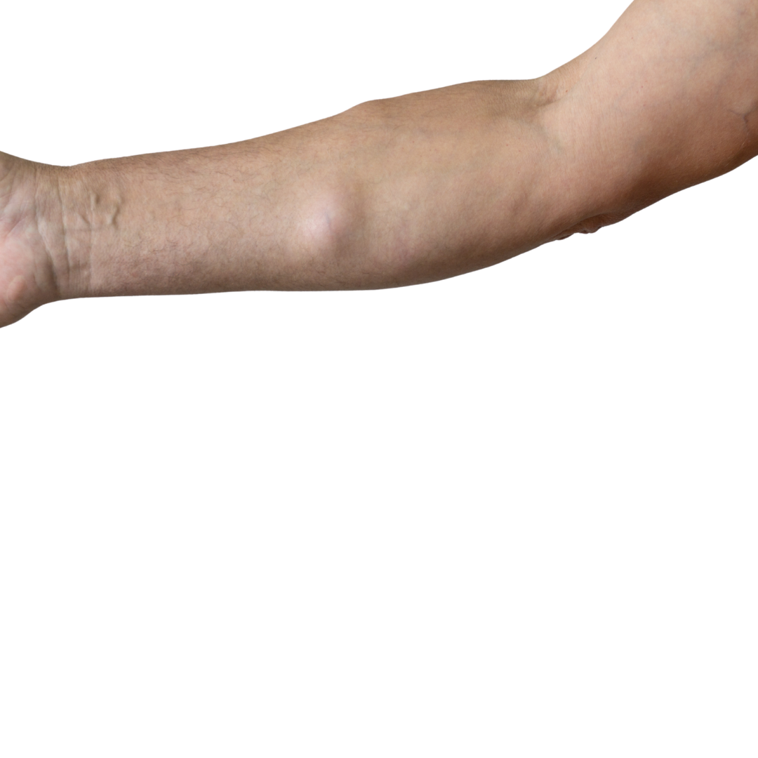 A visible lump beneath the skin of a forearm.