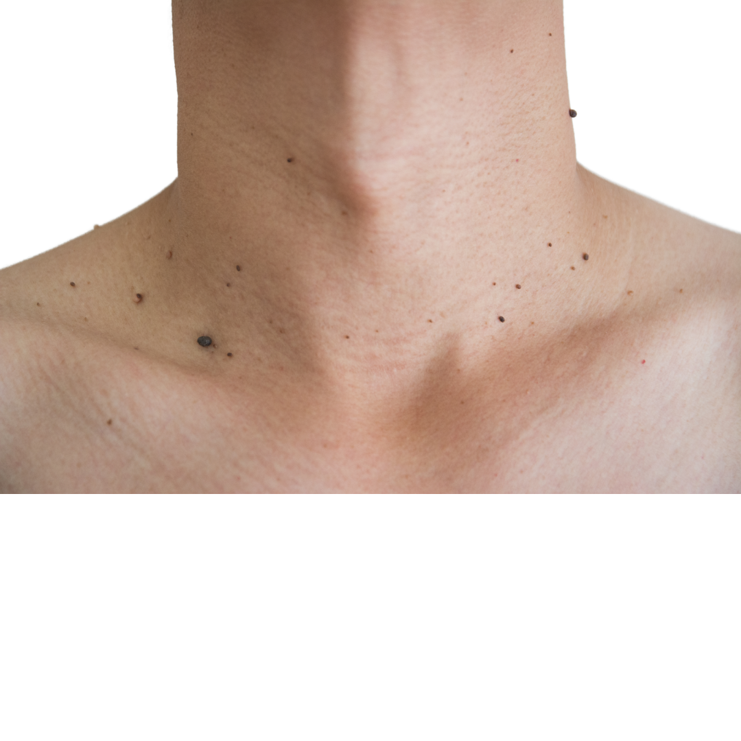 Raised skin spots around the neck and upper chest.