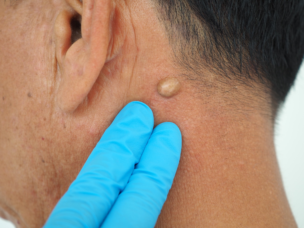 Gloved fingers beside a raised skin lump behind an ear.